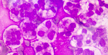 Cytology-for-Malignant-Cell Estimated Glomerular Filtration Rate