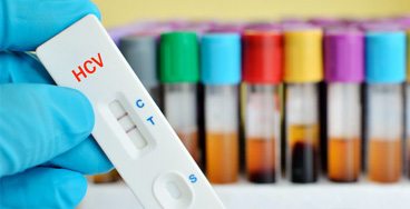 Hepatitis-C-virus-(HCV)-Rap Glucose fasting