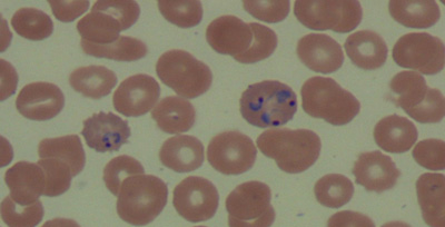 Malaria-Antigen-and-Periphe Malaria Antigen and Peripheral Smear