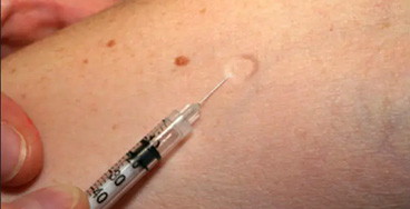 Mantoux-Test Mantoux Test