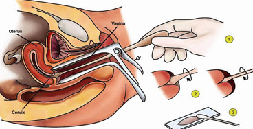 Pap-Smear-Conventional electrolytes with calcium test