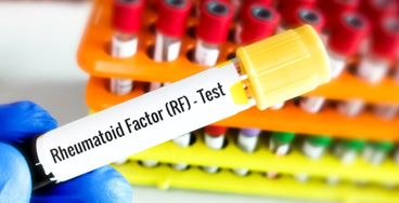 Rheumatoid-Factor Estimated Glomerular Filtration Rate