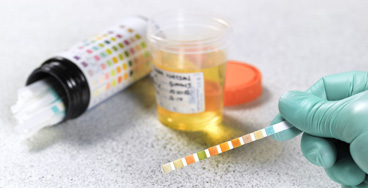 Urine-Glucose-Fasting-&-Po Urine Glucose Fasting & Post Prandial