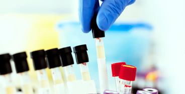 Urine-for-Cytology Urine for Cytology