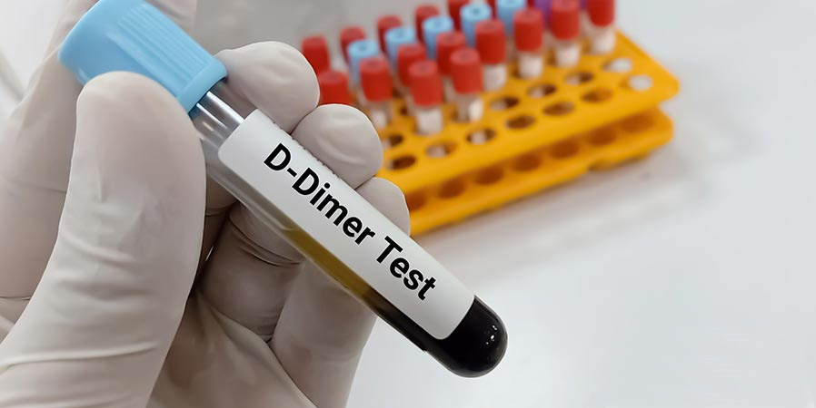 d-dimer-test D-Dimer Test